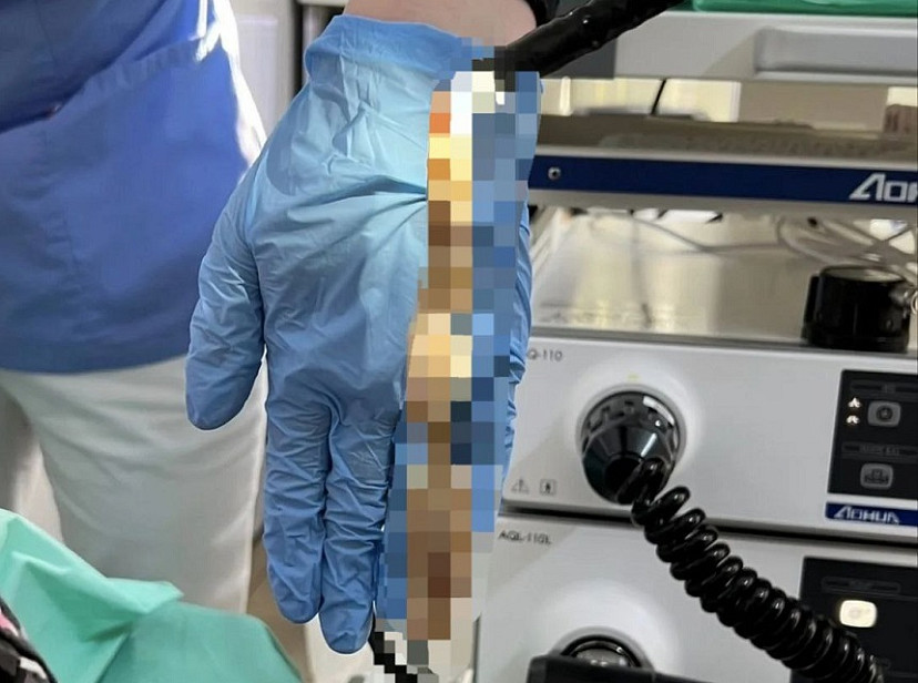 Пожилой саратовец проглотил крупный кусок кожи и оказался в больнице